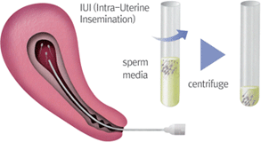 IUI (Inter-Uterine Insemination)
