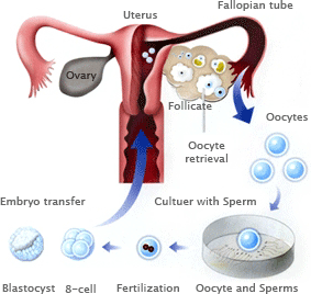 IVF Procedure